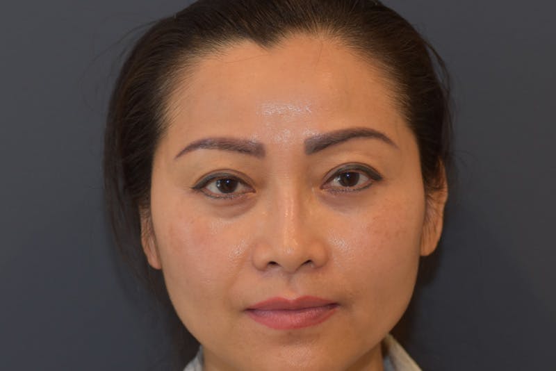 Upper Blepharoplasty Before & After Gallery - Patient 229968 - Image 1