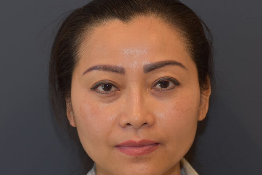 Upper Blepharoplasty Before & After Gallery - Patient 229968 - Image 1