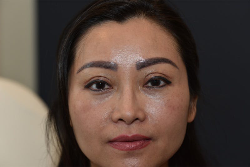 Upper Blepharoplasty Before & After Gallery - Patient 229968 - Image 2