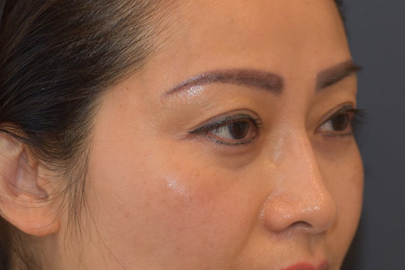 Upper Blepharoplasty Before & After Gallery - Patient 229968 - Image 3