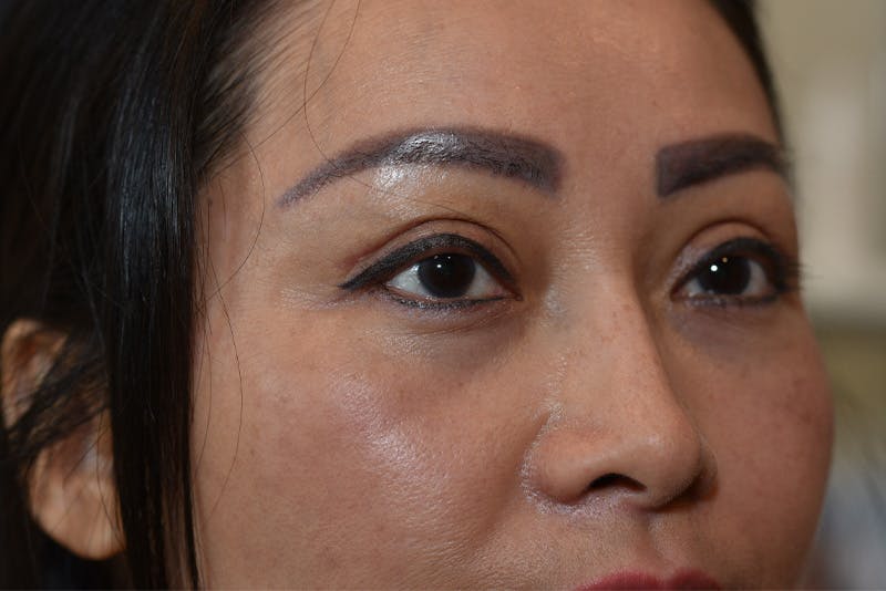 Upper Blepharoplasty Before & After Gallery - Patient 229968 - Image 4
