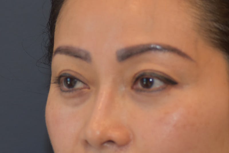 Upper Blepharoplasty Before & After Gallery - Patient 229968 - Image 5