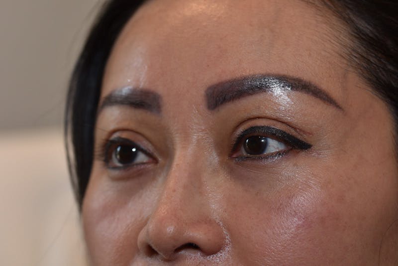 Upper Blepharoplasty Before & After Gallery - Patient 229968 - Image 6