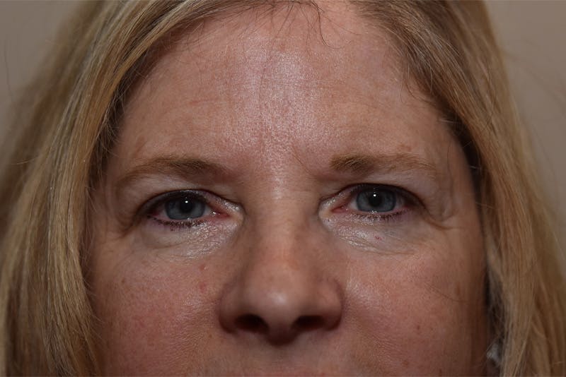 Upper Blepharoplasty Before & After Gallery - Patient 203858 - Image 1