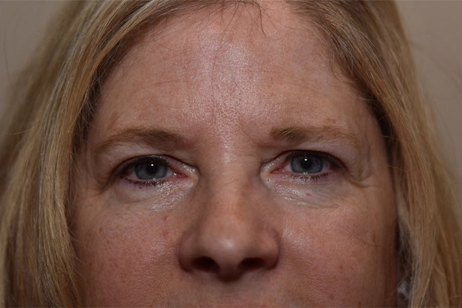 Upper Blepharoplasty Before & After Gallery - Patient 203858 - Image 1