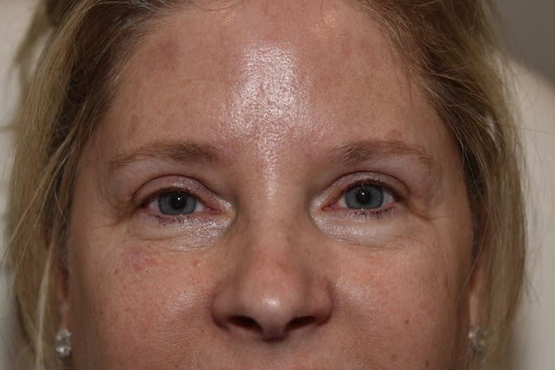 Upper Blepharoplasty Before & After Gallery - Patient 203858 - Image 2