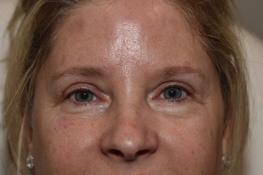 Upper Blepharoplasty Before & After Gallery - Patient 203858 - Image 2