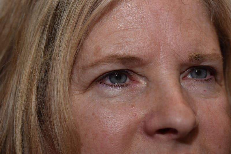 Upper Blepharoplasty Before & After Gallery - Patient 203858 - Image 3