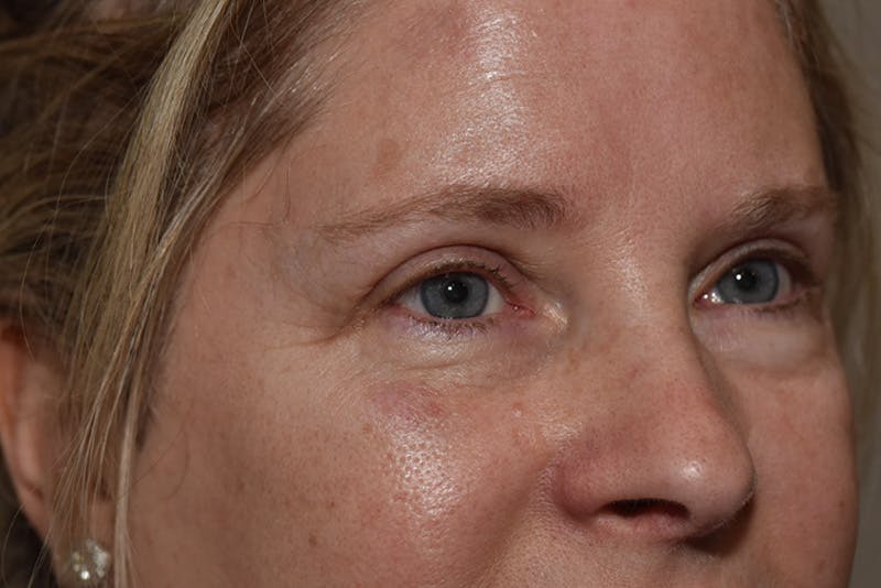 Upper Blepharoplasty Before & After Gallery - Patient 203858 - Image 4