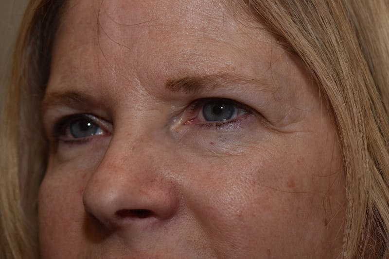 Upper Blepharoplasty Before & After Gallery - Patient 203858 - Image 5