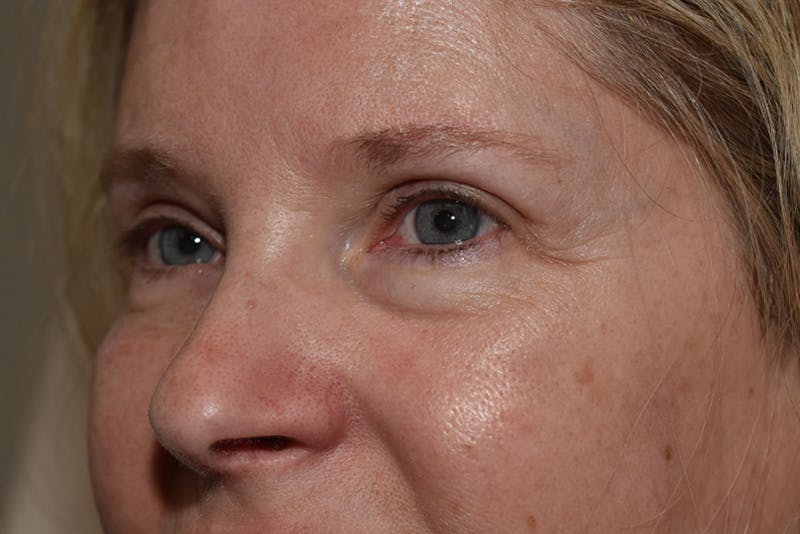 Upper Blepharoplasty Before & After Gallery - Patient 203858 - Image 6