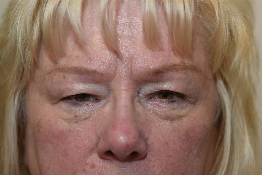 Upper Blepharoplasty Before & After Gallery - Patient 330464 - Image 1
