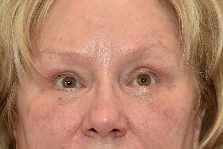 Upper Blepharoplasty Before & After Gallery - Patient 330464 - Image 2