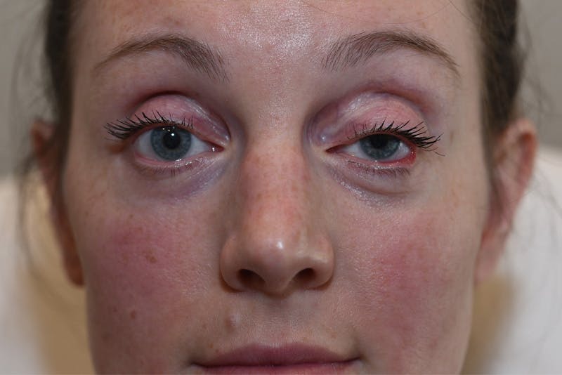 Upper Blepharoplasty Before & After Gallery - Patient 184493 - Image 1