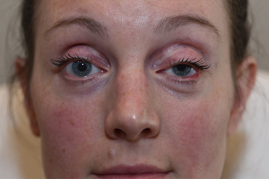 Upper Blepharoplasty Before & After Gallery - Patient 184493 - Image 1