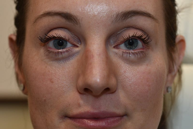 Upper Blepharoplasty Before & After Gallery - Patient 184493 - Image 2