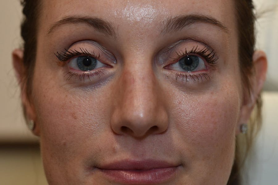 Upper Blepharoplasty Before & After Gallery - Patient 184493 - Image 2