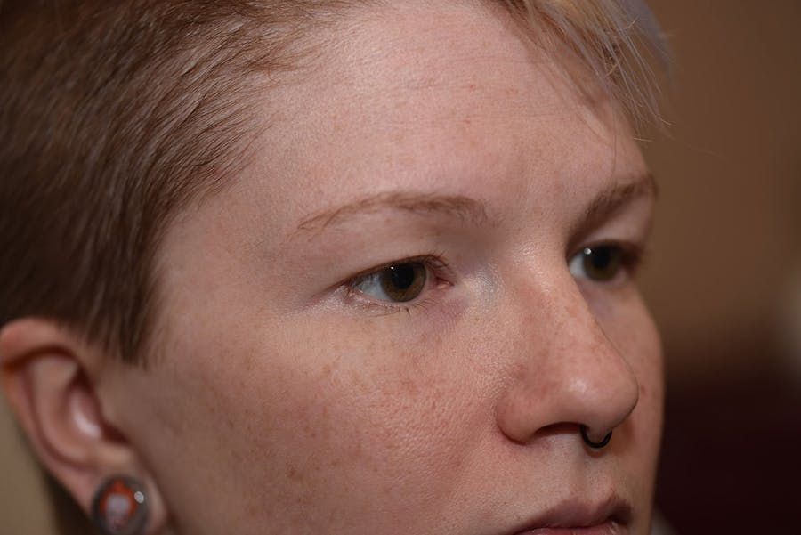 Upper Blepharoplasty Before & After Gallery - Patient 415881 - Image 1