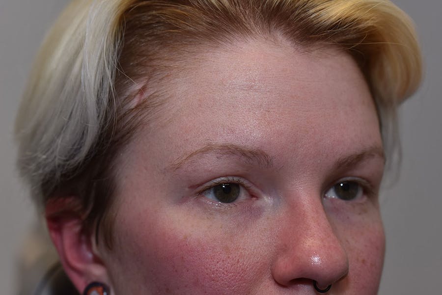 Upper Blepharoplasty Before & After Gallery - Patient 415881 - Image 2