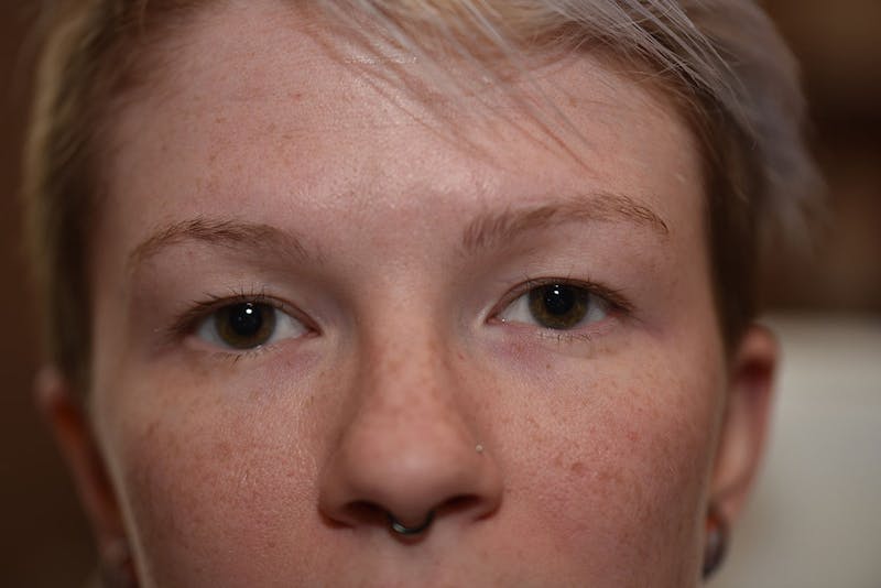 Upper Blepharoplasty Before & After Gallery - Patient 415881 - Image 3