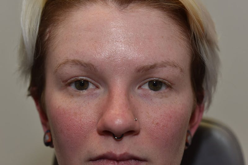 Upper Blepharoplasty Before & After Gallery - Patient 415881 - Image 4