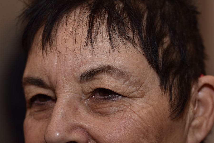 Upper Blepharoplasty Before & After Gallery - Patient 439803 - Image 1