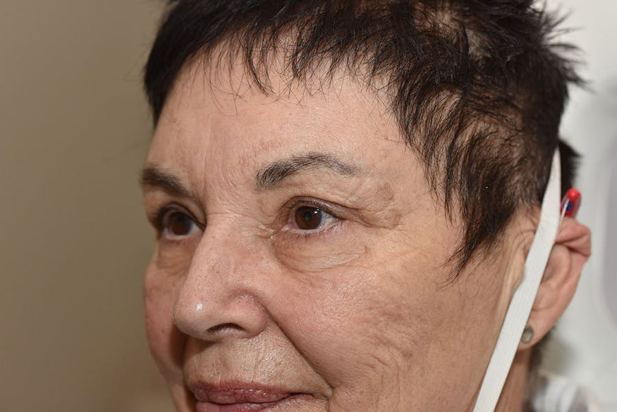Upper Blepharoplasty Before & After Gallery - Patient 439803 - Image 2