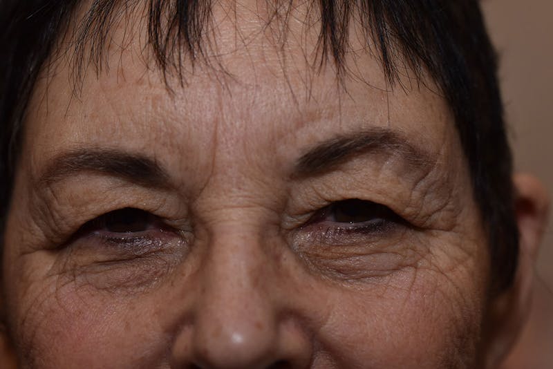 Upper Blepharoplasty Before & After Gallery - Patient 439803 - Image 3