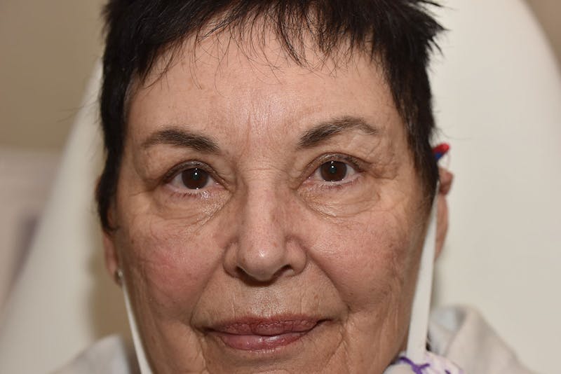 Upper Blepharoplasty Before & After Gallery - Patient 439803 - Image 4
