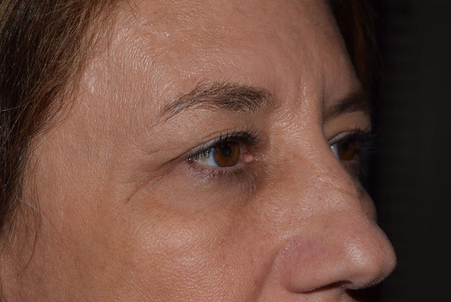 Upper Blepharoplasty Before & After Gallery - Patient 223927 - Image 1