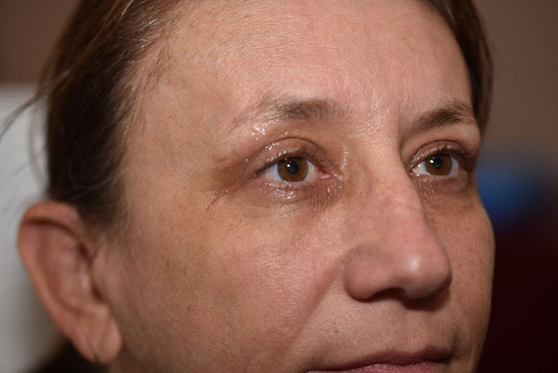 Upper Blepharoplasty Before & After Gallery - Patient 223927 - Image 2