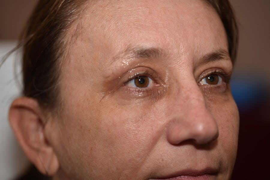 Upper Blepharoplasty Before & After Gallery - Patient 223927 - Image 2