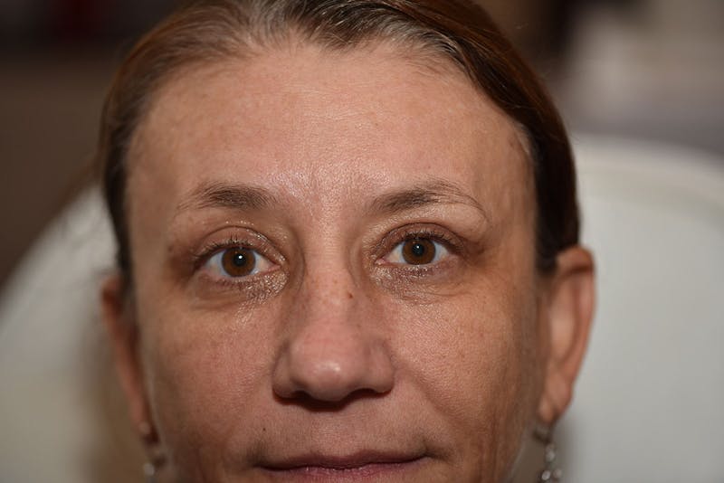 Upper Blepharoplasty Before & After Gallery - Patient 223927 - Image 4