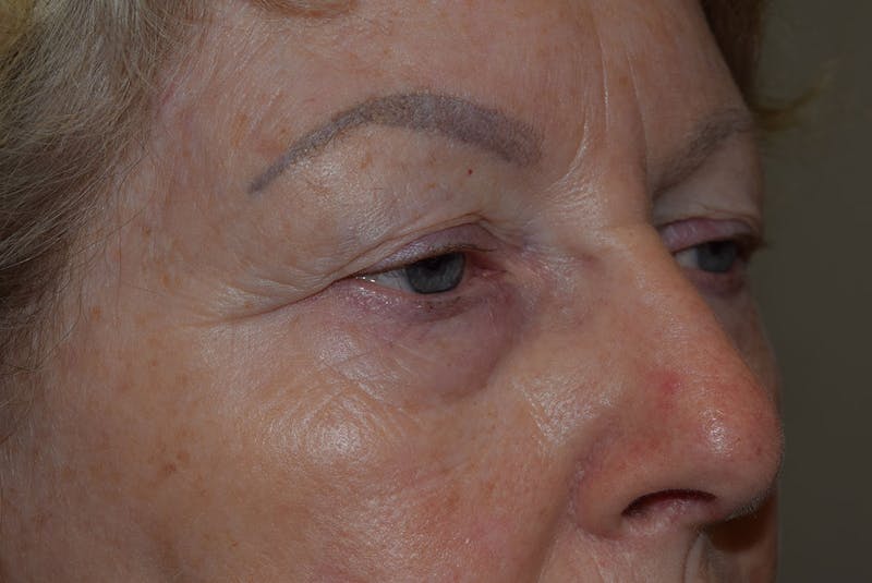 Upper Blepharoplasty Before & After Gallery - Patient 310011 - Image 1