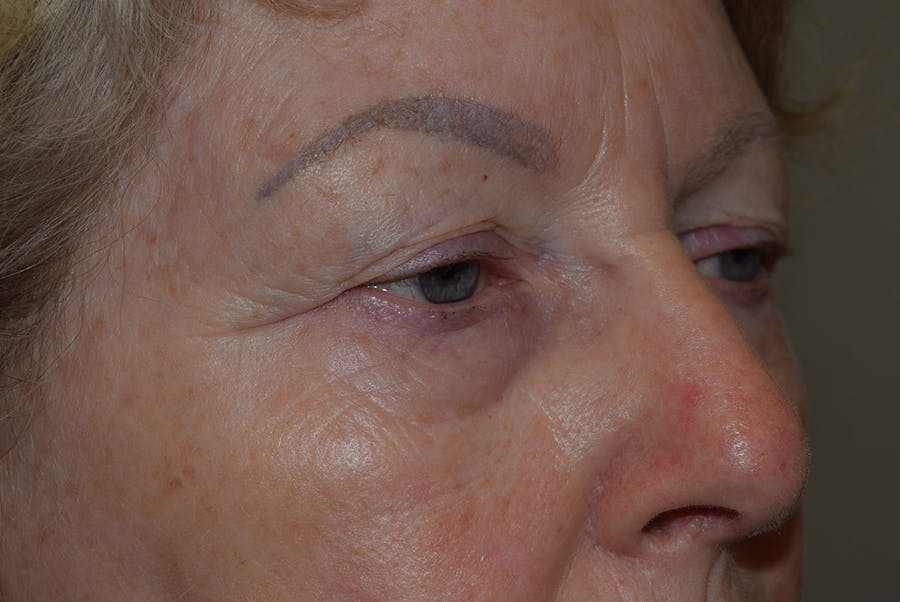 Upper Blepharoplasty Before & After Gallery - Patient 310011 - Image 1