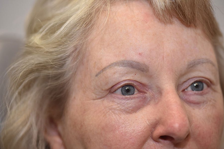Upper Blepharoplasty Before & After Gallery - Patient 310011 - Image 2