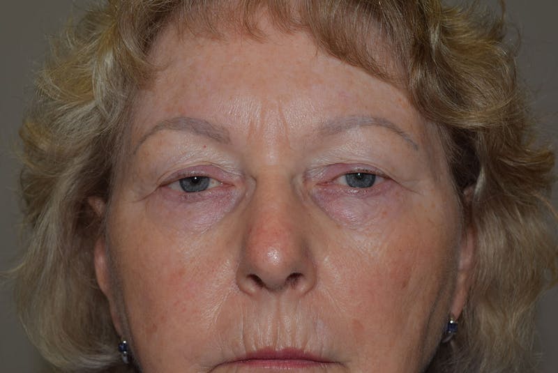 Upper Blepharoplasty Before & After Gallery - Patient 310011 - Image 3