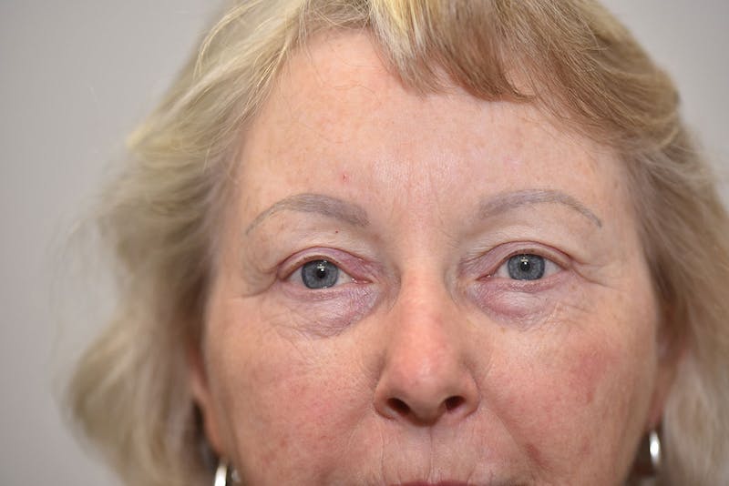 Upper Blepharoplasty Before & After Gallery - Patient 310011 - Image 4