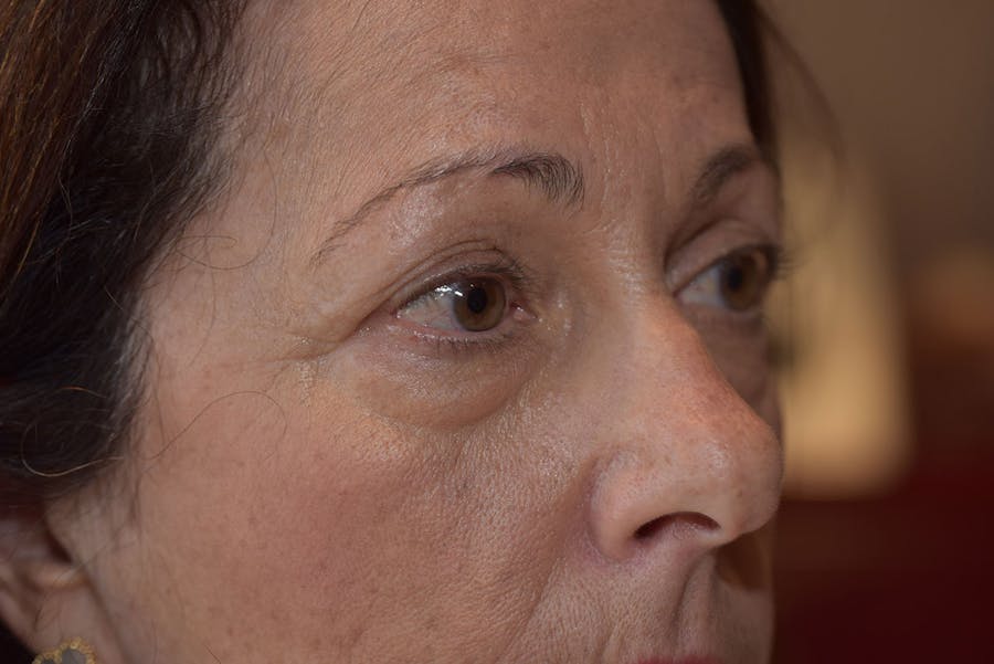 Upper Blepharoplasty Before & After Gallery - Patient 408626 - Image 1