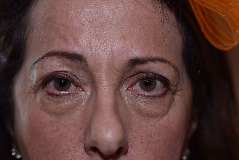 Upper Blepharoplasty Before & After Gallery - Patient 408626 - Image 3