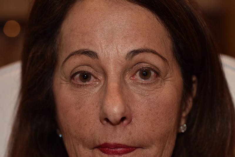 Upper Blepharoplasty Before & After Gallery - Patient 408626 - Image 4