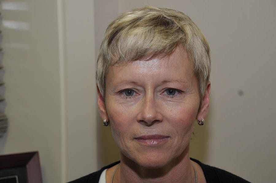 Upper Blepharoplasty Before & After Gallery - Patient 130604 - Image 1