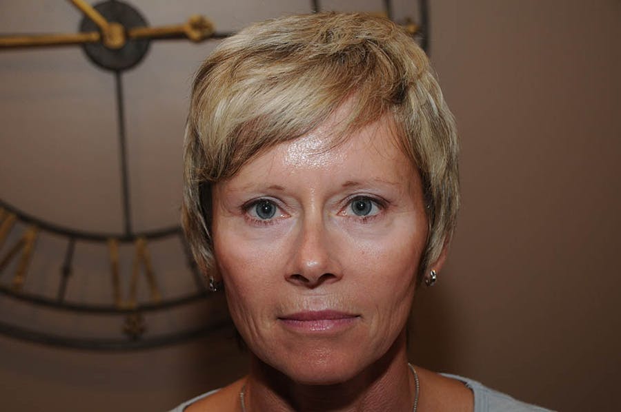 Upper Blepharoplasty Before & After Gallery - Patient 130604 - Image 2