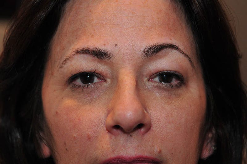 Upper Blepharoplasty Before & After Gallery - Patient 265842 - Image 1