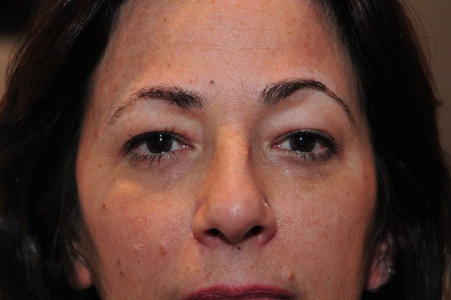 Upper Blepharoplasty Before & After Gallery - Patient 265842 - Image 1