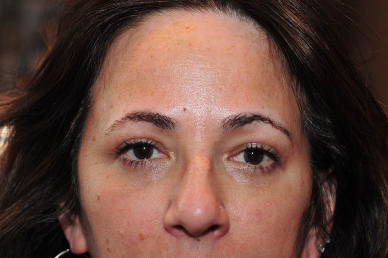 Upper Blepharoplasty Before & After Gallery - Patient 265842 - Image 2