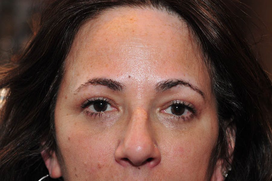 Upper Blepharoplasty Before & After Gallery - Patient 265842 - Image 2