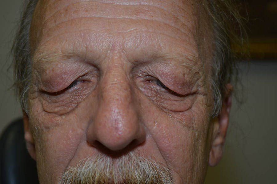 Upper Blepharoplasty Before & After Gallery - Patient 120489 - Image 1