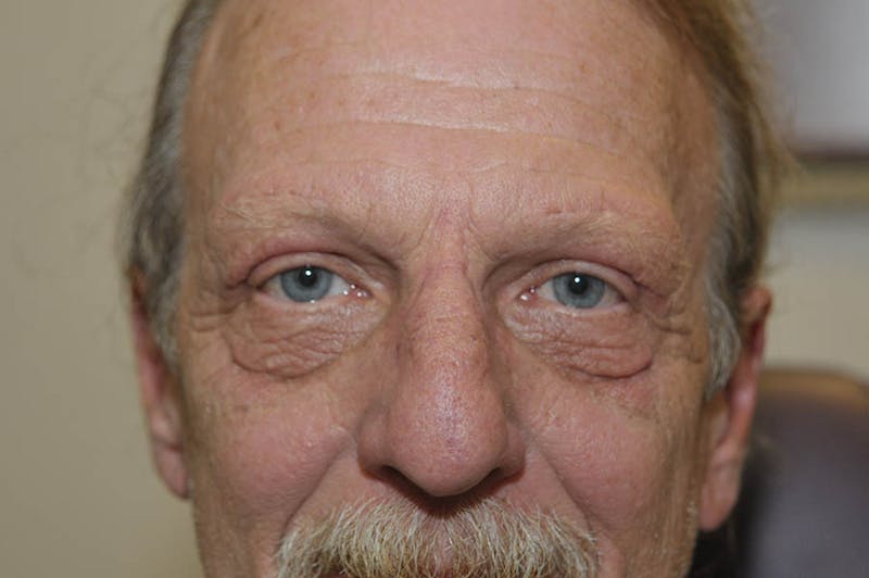 Upper Blepharoplasty Before & After Gallery - Patient 120489 - Image 2