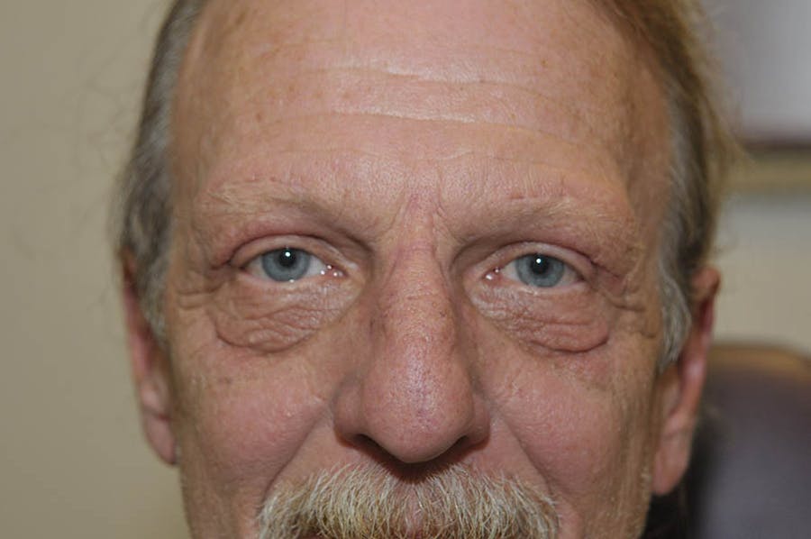 Upper Blepharoplasty Before & After Gallery - Patient 120489 - Image 2